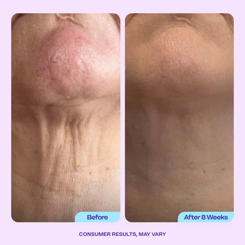 VURIEXO Miracle Neck Cream: Erase "Turkey Neck" & "Tech Neck" Lines Visible Lift & Smoothness in 4 Weeks