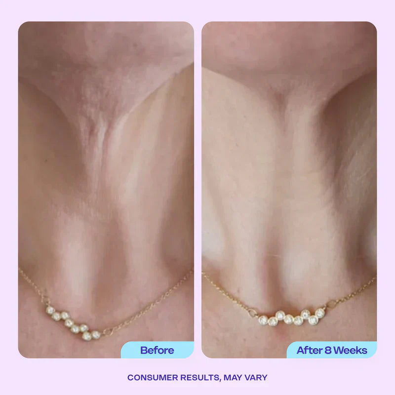 VURIEXO Miracle Neck Cream: Erase "Turkey Neck" & "Tech Neck" Lines Visible Lift & Smoothness in 4 Weeks
